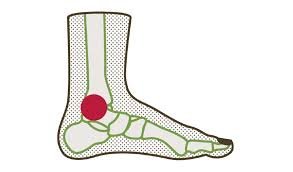 Tarsal Tunnel Syndrome Treatment in Delhi